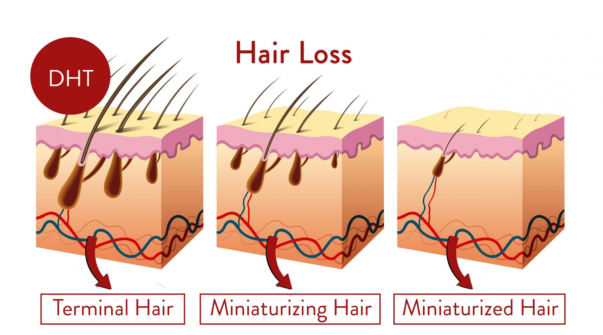 The Science Behind DHT Blocker Results for Hair Fall  Clinikally