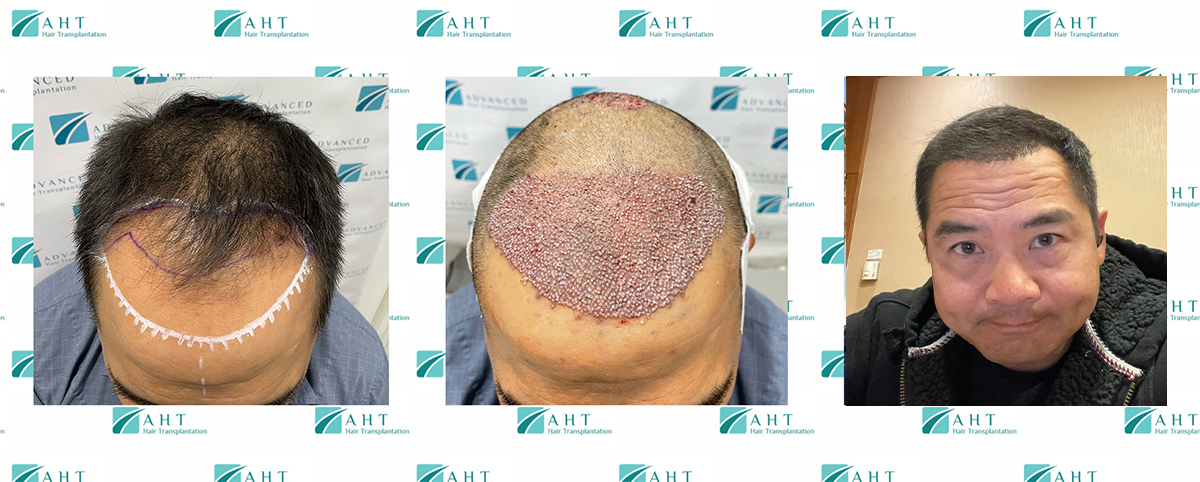 Transplantacija kose, frontalna linija, odličan rezultat, AHT metod
