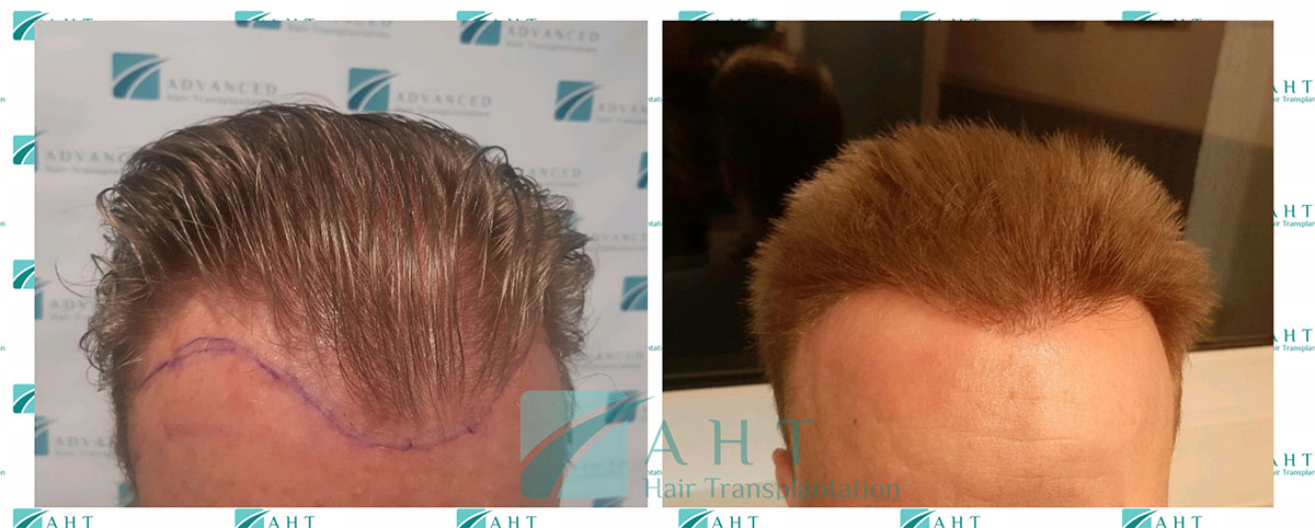 Presadjivanje kose AHT metodom, 6 meseci nakon presadjivanja kose