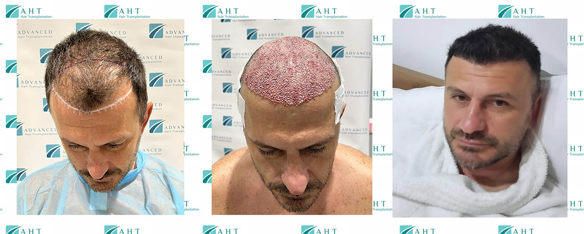 Transplantacija kose frontalne linije 4500 folikula, odlican rezultat nakon 5 meseci