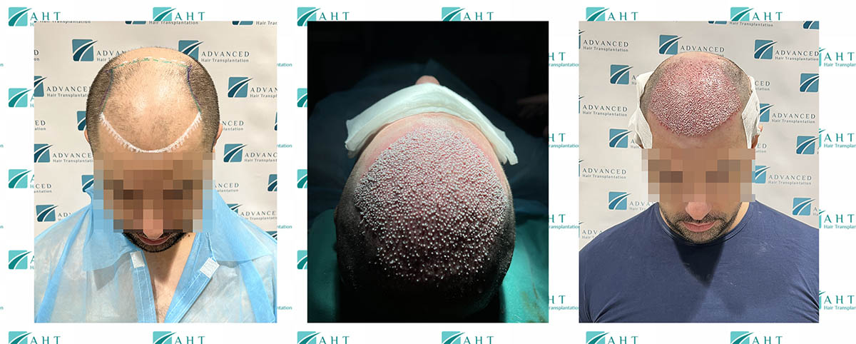 Presadjivanje kose, pozitivna iskustva pacijenta, 4500 folikula