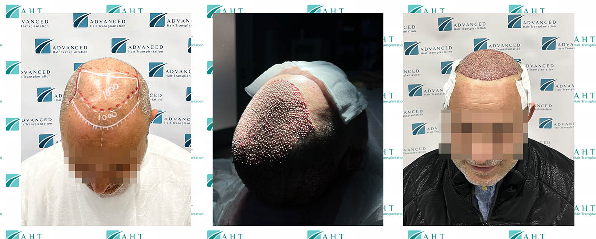 Transplantacija kose prednjeg dela, frontalne linije, kompletnog srednjeg dela, 4070 folikula