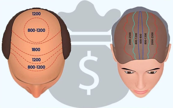 Follicle count - hair transplant assessment