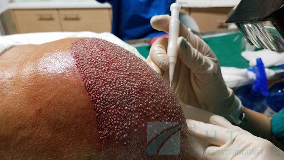Hair transplantation, AHT method, work with an implanter approx