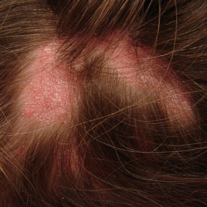 Cikatricijalna alopecija i kako je izlečiti?