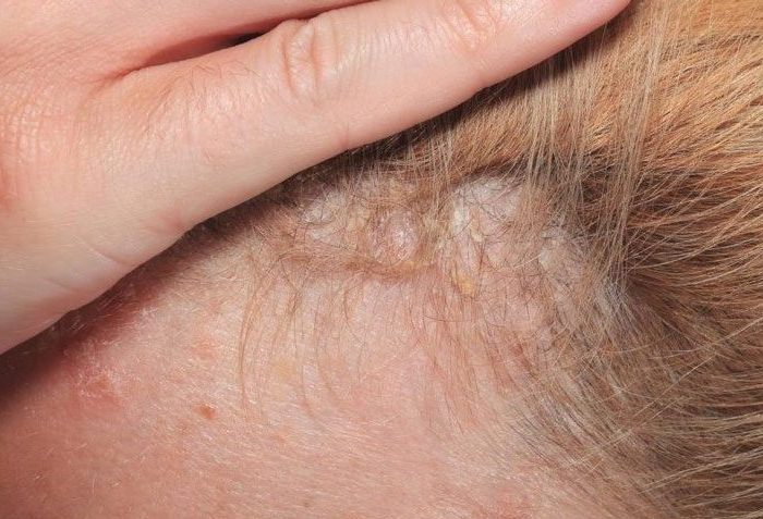 Crvenilo na koži, proverite da nije psorijaza