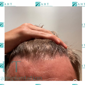Vucna celavost ili trakciona alopecija