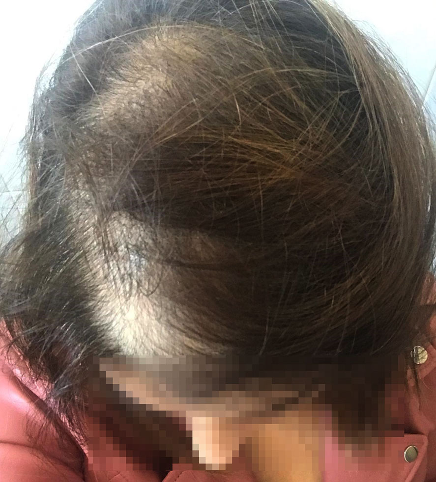 PCOS as a cause of hair loss