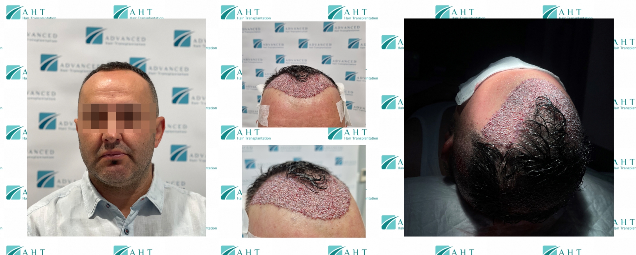 Hair transplantation in the frontal part of the head