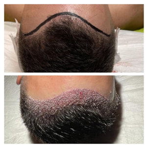 Spuštanje prednje frontalne linije transplantacijom kose
