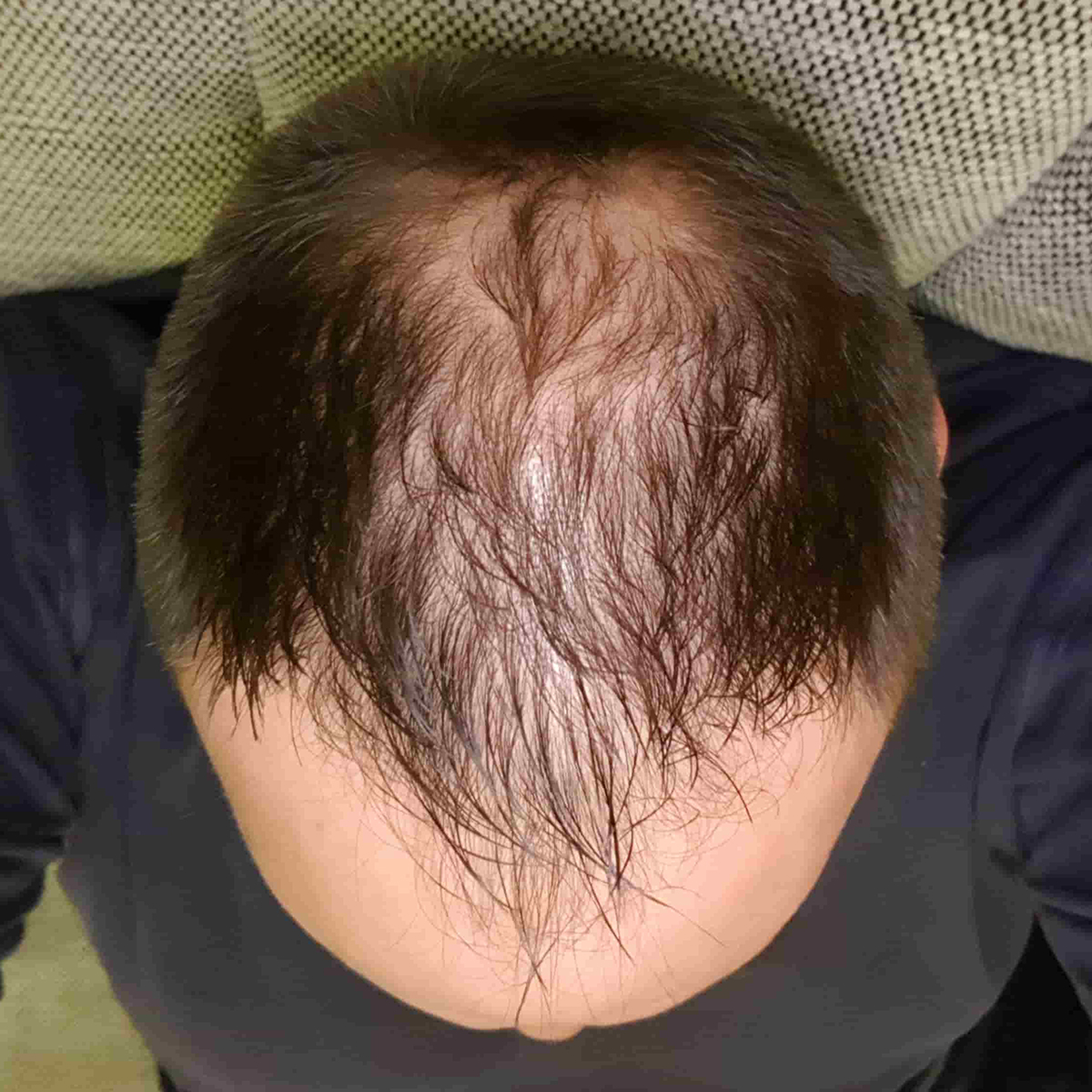 Šta je androgena alopecija?