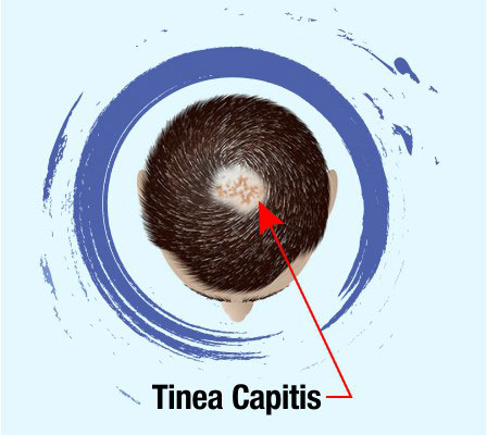 Tinea Capitis - infekcija vlasišta