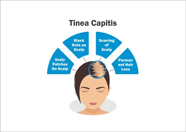 Tinea Capitis - infekcija vlasišta
