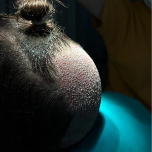 Vucna celavost ili trakciona alopecija