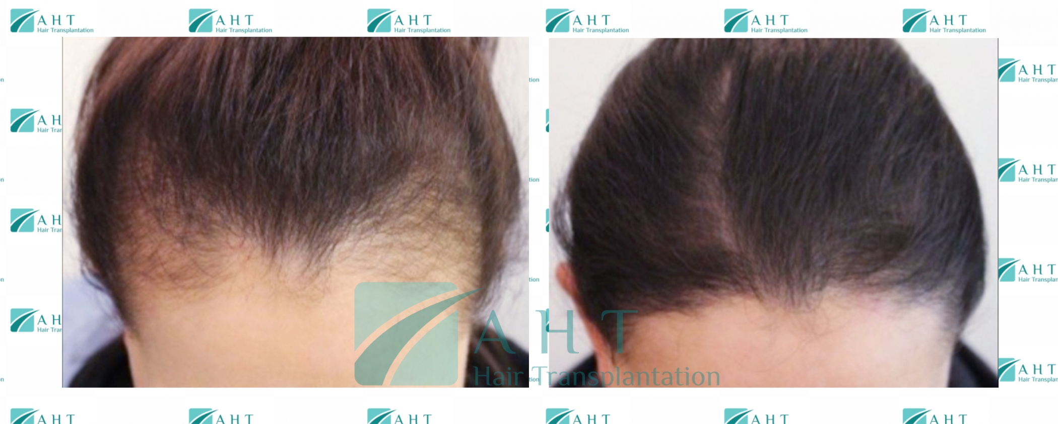 Hair transplantation is a solution for women as well